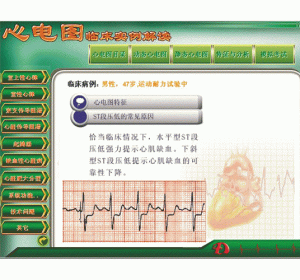 新版心电图教学软件心电图临床实例解读