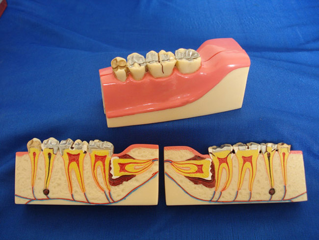 右下后牙组织分解模型