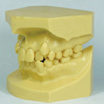 错颌畸形分类演示模型A